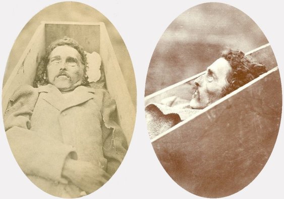 Frontal and Profile Views of the Corpse in the Hillmon Case.

Archives: National Archives and Records Administration in Kansas City, Missouri.

Photos courtesy of Marianne Wesson.