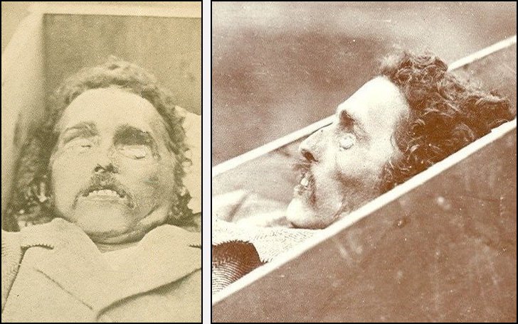 Frontal and Profile Views of the Corpse in the Hillmon Case.

Archives: National Archives and Records Administration in Kansas City, Missouri.

Photos courtesy of Marianne Wesson.